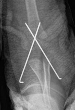  postoperative radiograph was taken after closed reduction with percutaneous fixation using medial and lateral K-wires