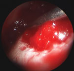 Curettage of an osteochondral defect leaves a large hole