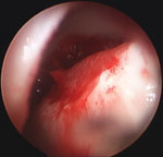 the final appearance of the patched osteochondral defect