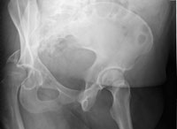 radiographs of an acetabular fracture