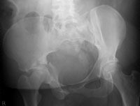 Judet plain radiograph of an acetabular fracture