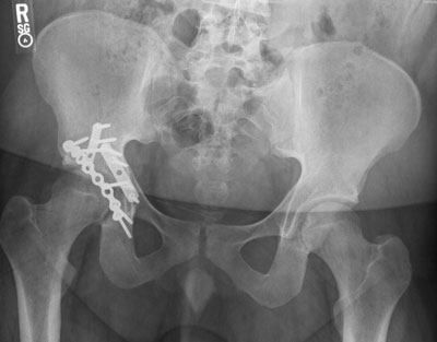  postoperative plain radiograph of an acetabular fracture patient