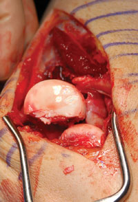 a Mason III radial head and neck fracture