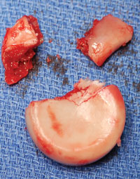 The extracted radial head three-part fracture