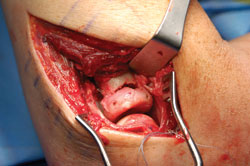 A provisional reduction of Mason III fracture 