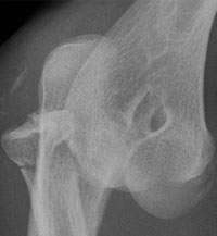  a Mason III fracture with an elbow dislocation