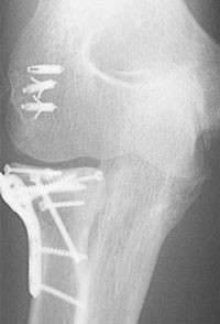 postoperative ORIF with extensor mass and lateral collateral ligament repairs