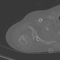 preoperative CT scan