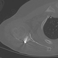 A postoperative CT scan 