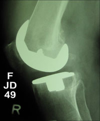 bilateral cementless knee prostheses at 5 months in the right knee