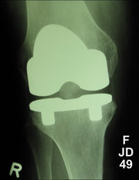 bilateral cementless knee prostheses at 5 months in the right knee