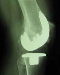  bilateral cementless knee prostheses at 5 years in the left knee 