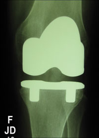  bilateral cementless knee prostheses at 5 years in the left knee 