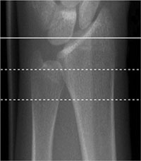 a 3-D reconstruction of high-resolution peripheral CT image