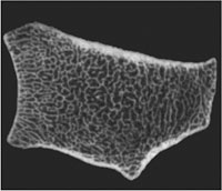 3-D reconstruction of high-resolution peripheral CT image of the distal radius