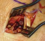 An intraoperative image of exposure with retraction