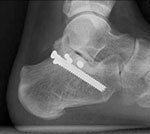 a calcaneus fracture fixed via the sinus tarsi approach with independent screw fixation