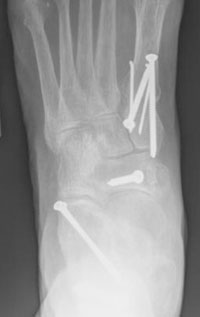 postoperative AP X-ray shows the correction after reconstruction.