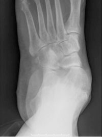 anteroposterior (AP) X-ray of a patient with flatfoot deformity