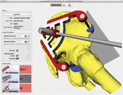 The patient-specific 3-D plan for cup alignment