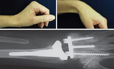 The 5-year follow-up radiographs and clinical images of a patient who underwent a total wrist arthroplasty