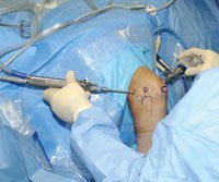 The arthroscope is placed in the medial portal,