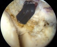 A radiofrequency probe is then used to resect the ECRB tissue.