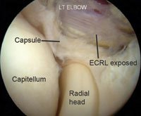 An angled scope is used to visualize the exposed ECRL and ECRB