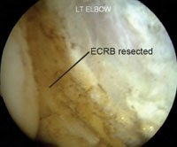 The completed resection of the ECRB is shown.