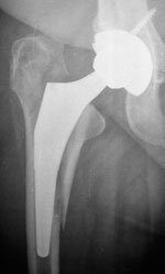 early periprosthetic fracture of the femur