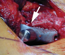 An intraoperative fracture of the proximal femoral metaphysis