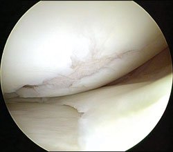 A grade III ICRS full-thickness isolated cartilage defect