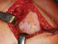 a patient treated with autologous chondrocyte implantation