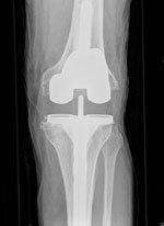  a postoperative view of a revised knee