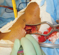 the lateral metaphysis with retractors in place