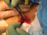 The surgeon collects the cancellous bone using a curette