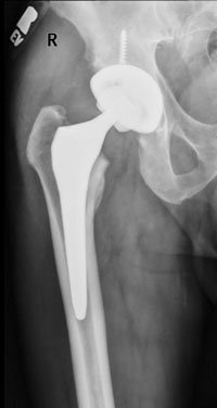 a postoperative AP radiograph of a hip implant