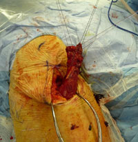 the tendon is exposed via a longitudinal incision and freed up to facilitate passing two Krackow sutures