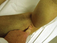 a bowstring sign for a proximal hamstring tear