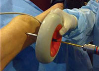 The surgeon holds the electromagnetic device against the skin over the locking holes