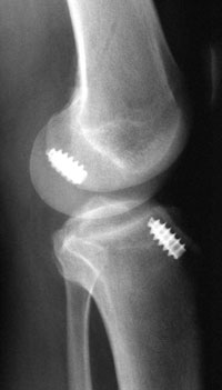 lateral radiograph of failed ACL reconstruction