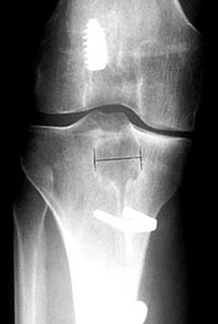 AP radiograph of a failed ACL reconstruction with allograft tissue 