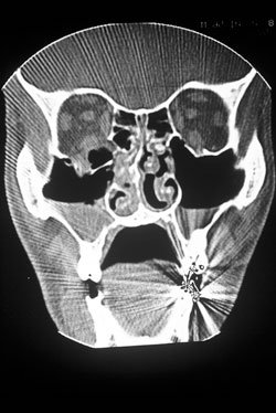 This facial CT scan shows the severe nasal fracture and bilateral orbital blow-out fractures