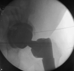 A fluoroscopic image showing hip aspiration