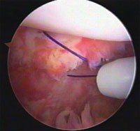 Preoperative MPFL image