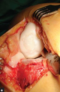 Arthrotomic osteochondral defects exposure