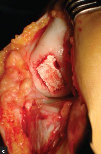 Osteochodral scaffold implantation