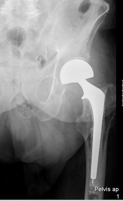 A cemented hemiarthroplasty with a bipolar head