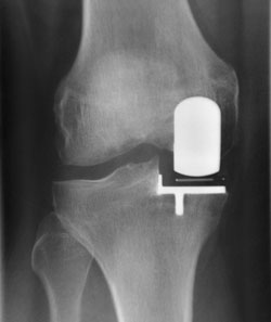 A patient with cementless medial unicompartmental replacement