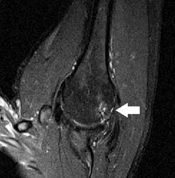 Abduction/external rotation view of shoulder